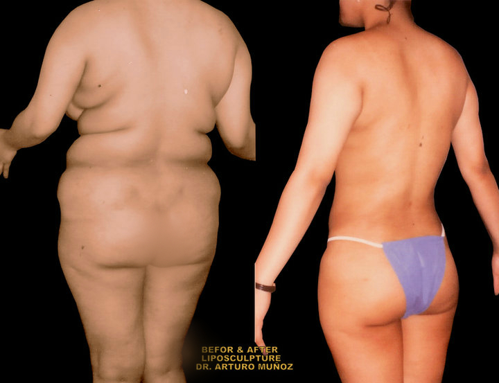 Full body lipo...anyone had it or researched it? Amazing results pics