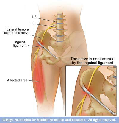 Meralgia Paresthetica - anyone else experienced this complication? Help!