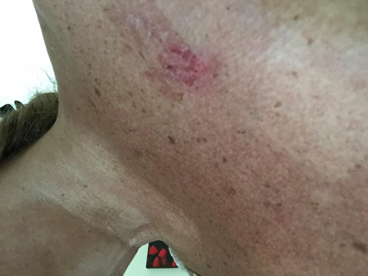Patch MD Issue