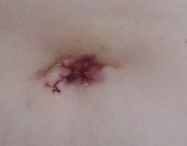 I am 8 days SILS lapband post op, how does my belly button wound look?