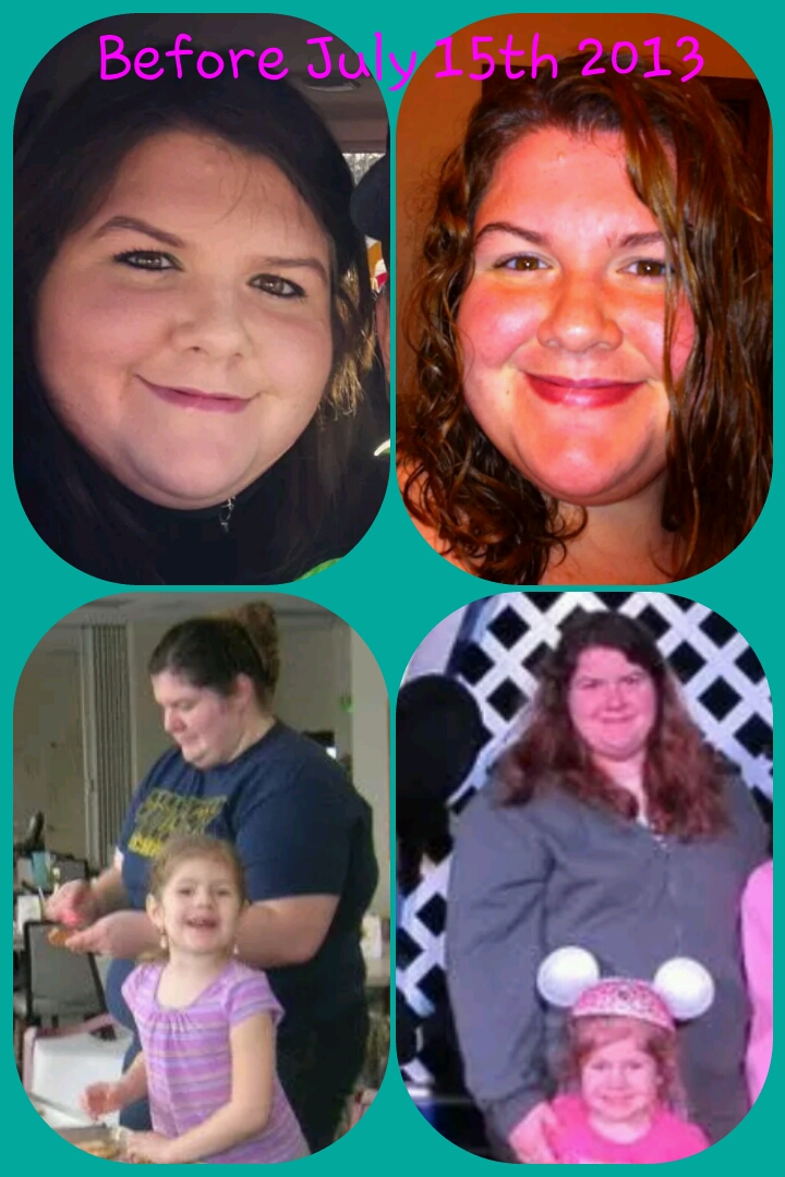 July 15th, 1 year surgiversary! :)