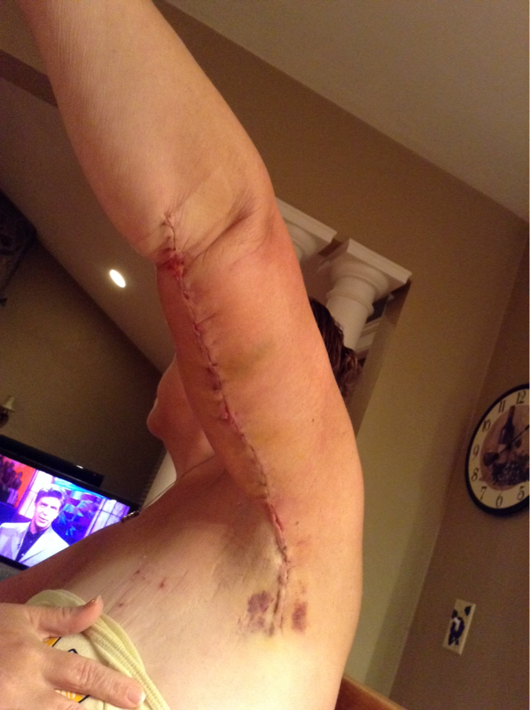 Brachioplasty-Arm Lift completed! Dr. Juan Pablo Cervantes