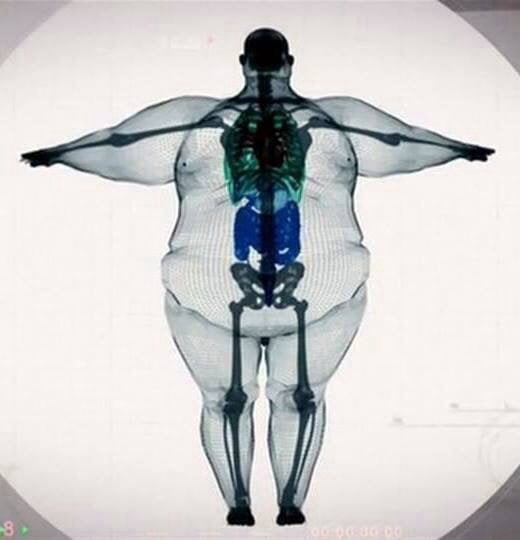 Perspective on Obesity and Orthopedic Issues