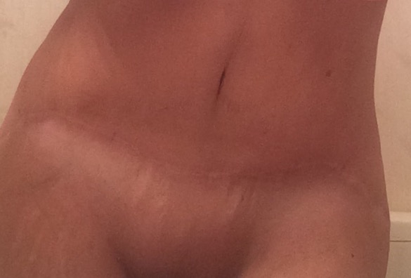Plastic surgery patient wins malpractice suit