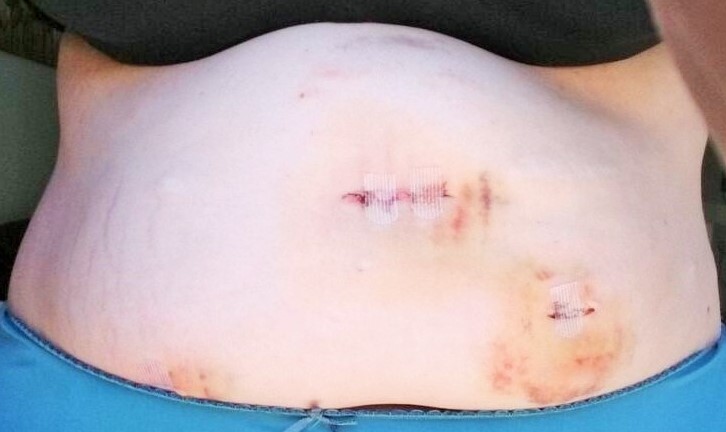 Band removed today....one step closer to bypass