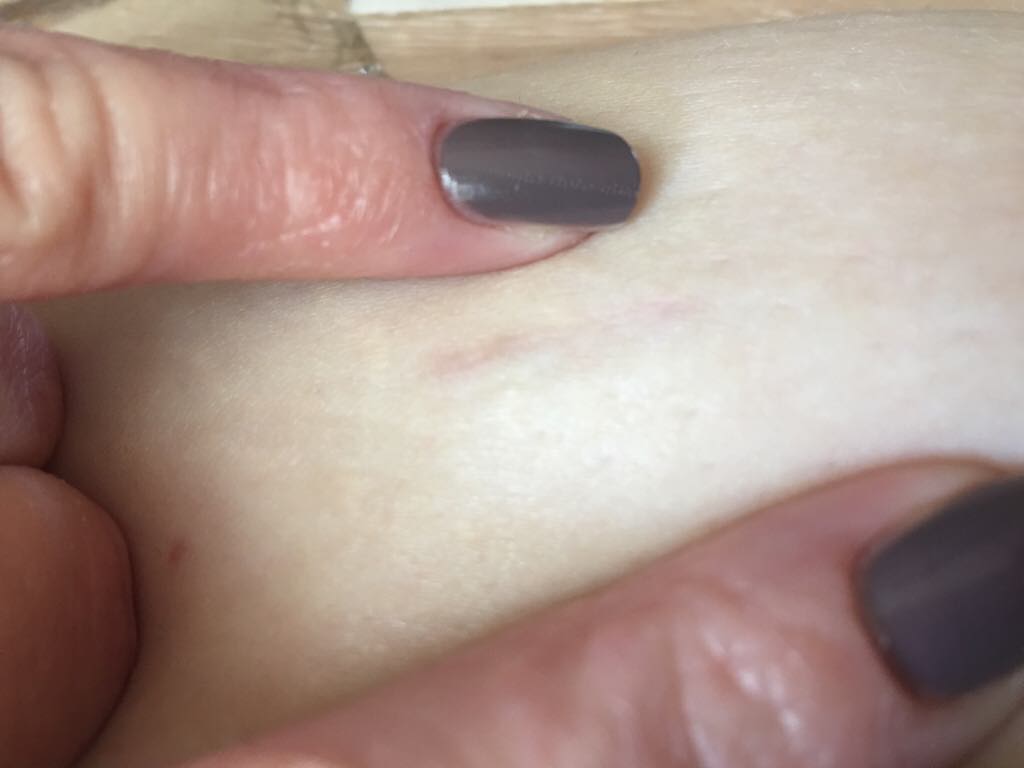Single Incision Laparoscopic Sleeve, Anyone?