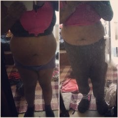 Left is before my surgery in 2016. Right side was taken in June 2017