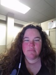 rosacea before