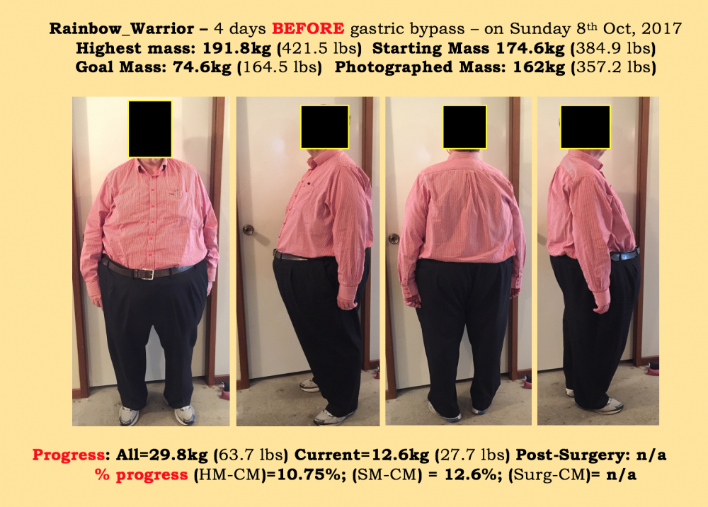 RW_Before_Gastric_Band.thumb.jpeg.6d8fb669be841b6b9996aa9a6a122d1a.jpeg