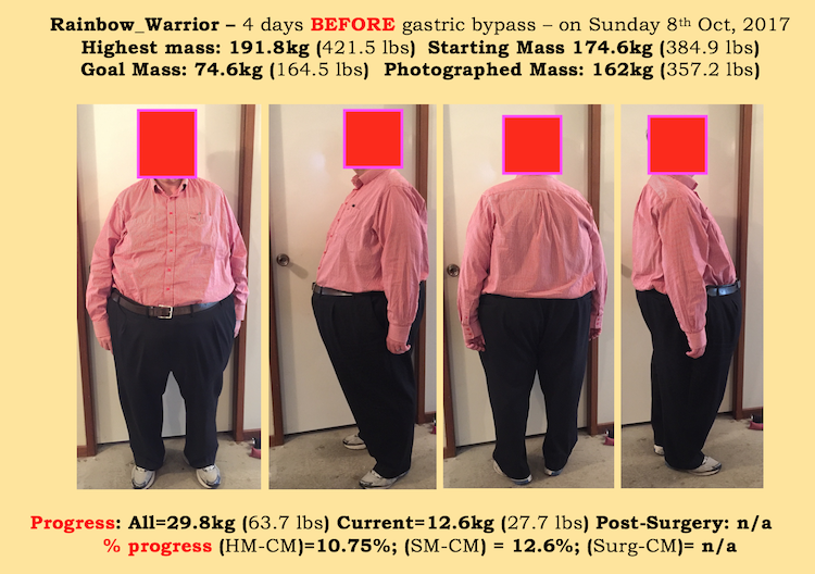 RW_presurgery.jpeg.f00e0227ee6c54d2c3054a77c0fbee5a.jpeg