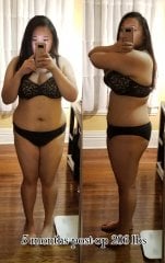 5 months post op