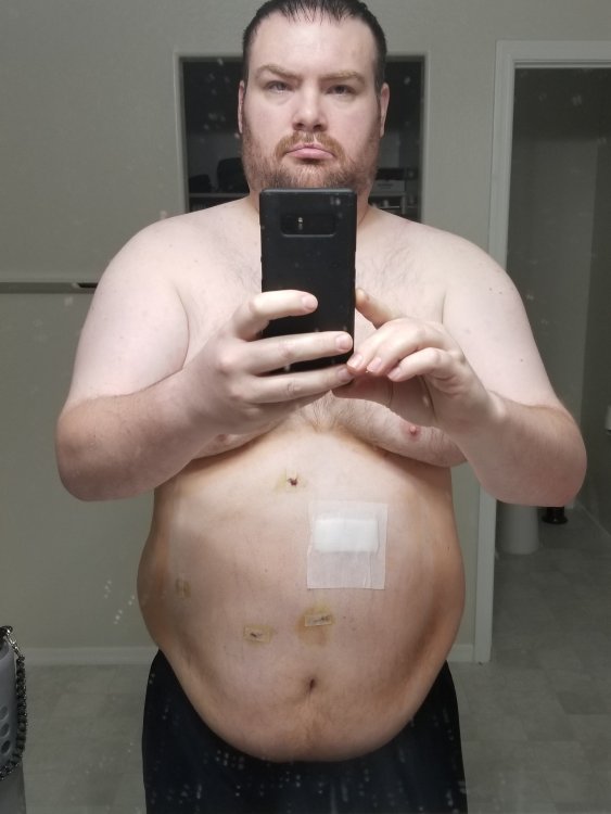 Post Surgery 11-24-2017.jpg