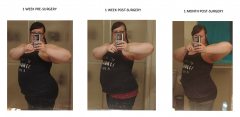 1 month post op