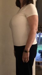 Before/3 days post surgery