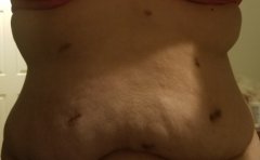 belly 4 months after surgery
