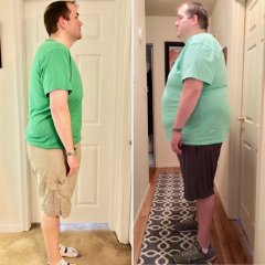 1 Year Post Op