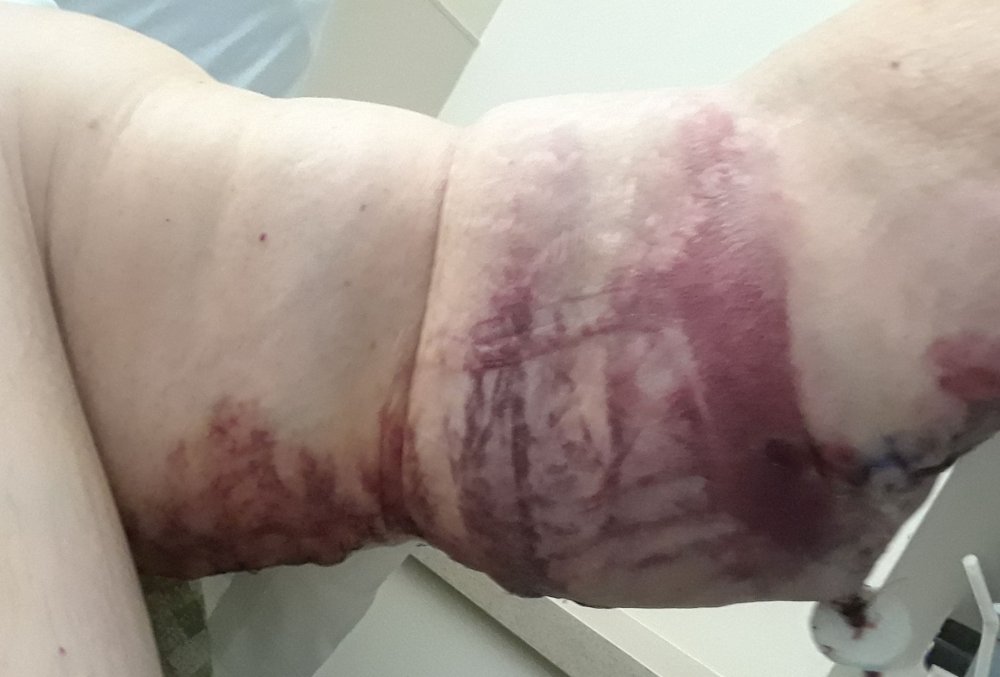 dayafter hemotoma.jpg