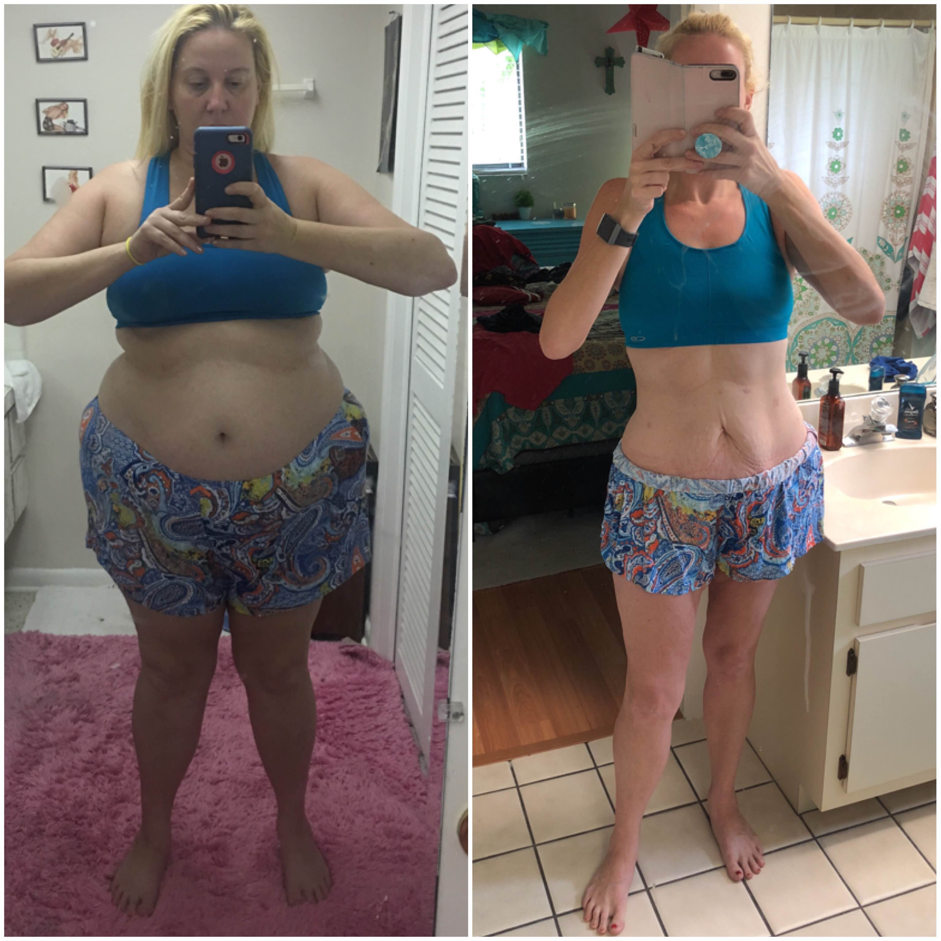 Before and after, two weeks shy of my 1 year surgiversay