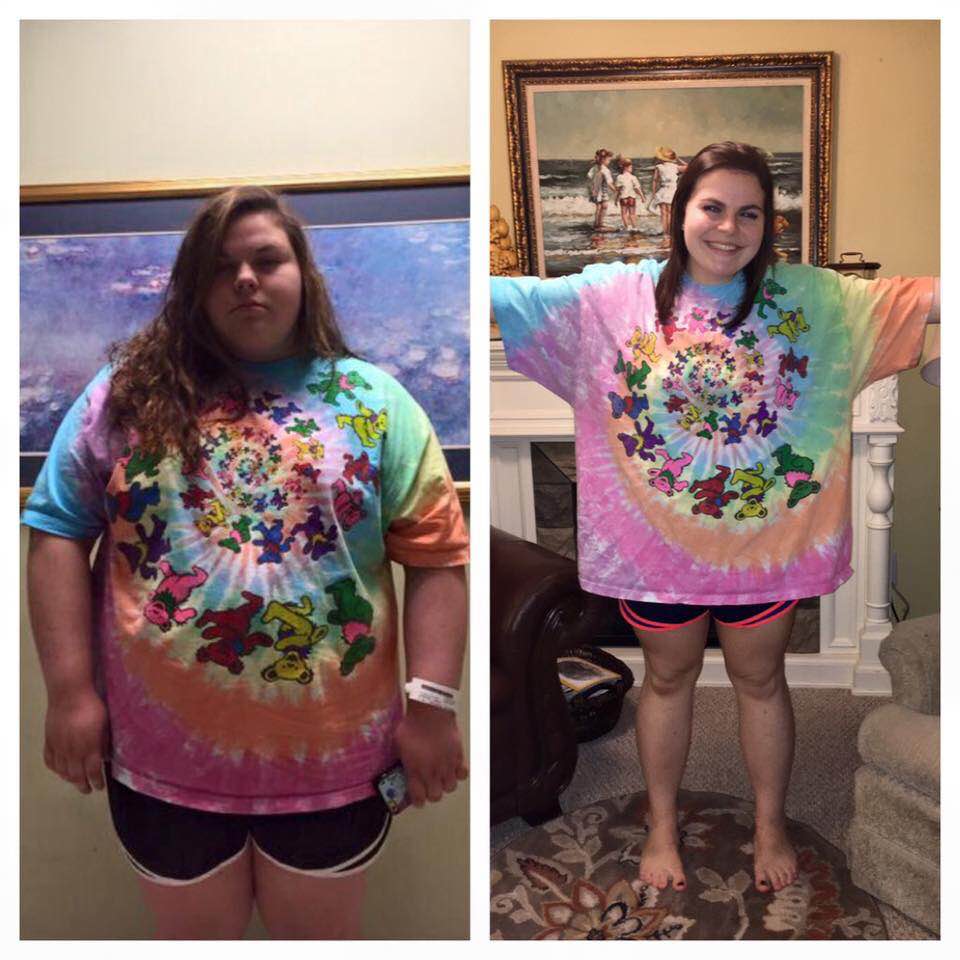 Gastric Sleeve at Age 18