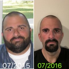 1 year Post VSG