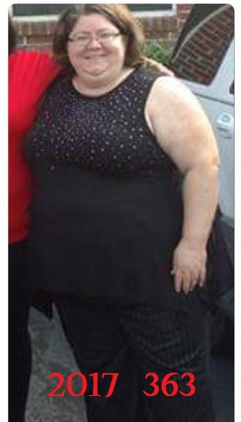 Before Surgery