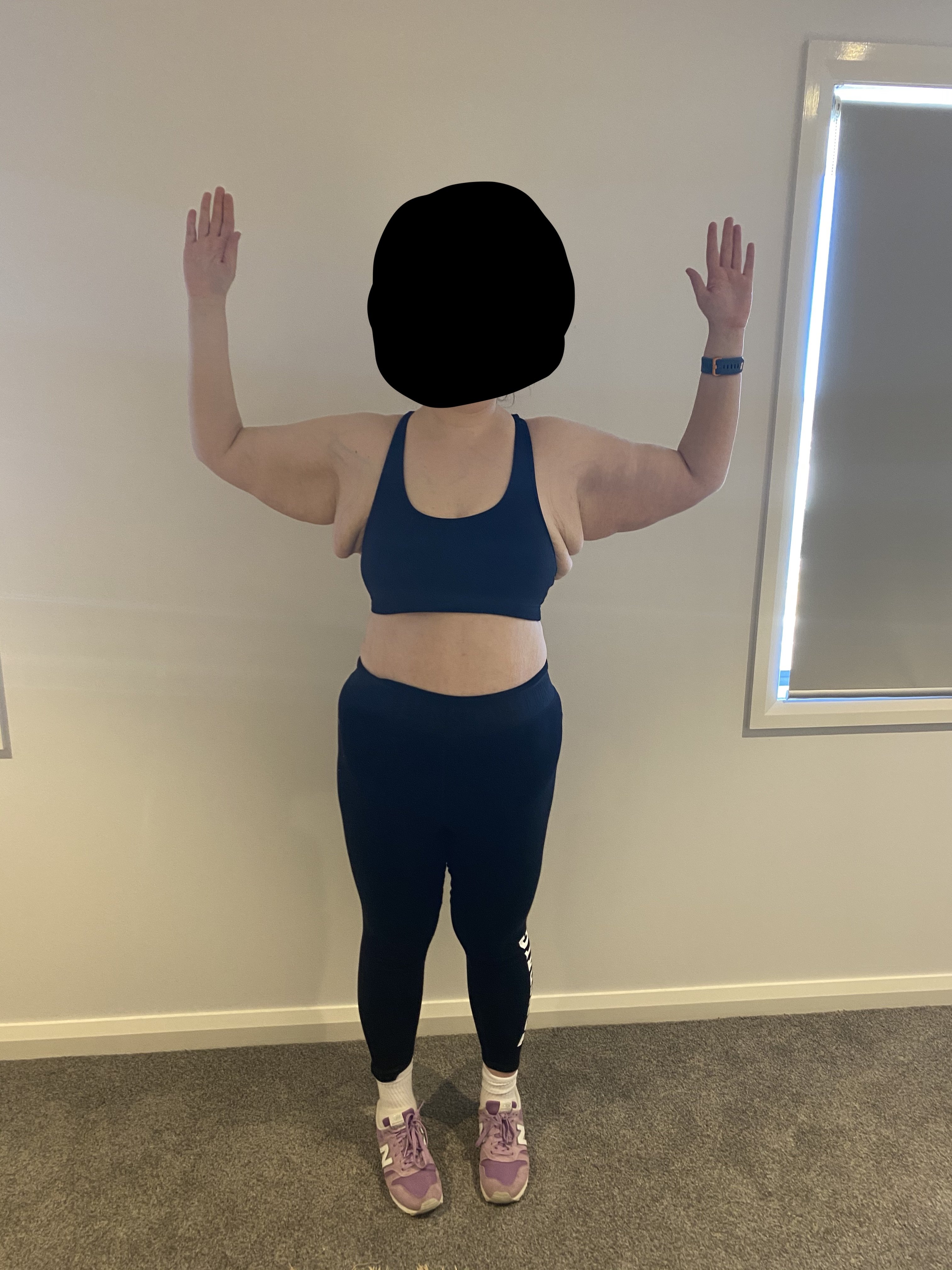 Arm lift next week - VERY UNPREPARED