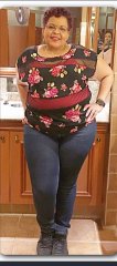 Before VSG surgery 