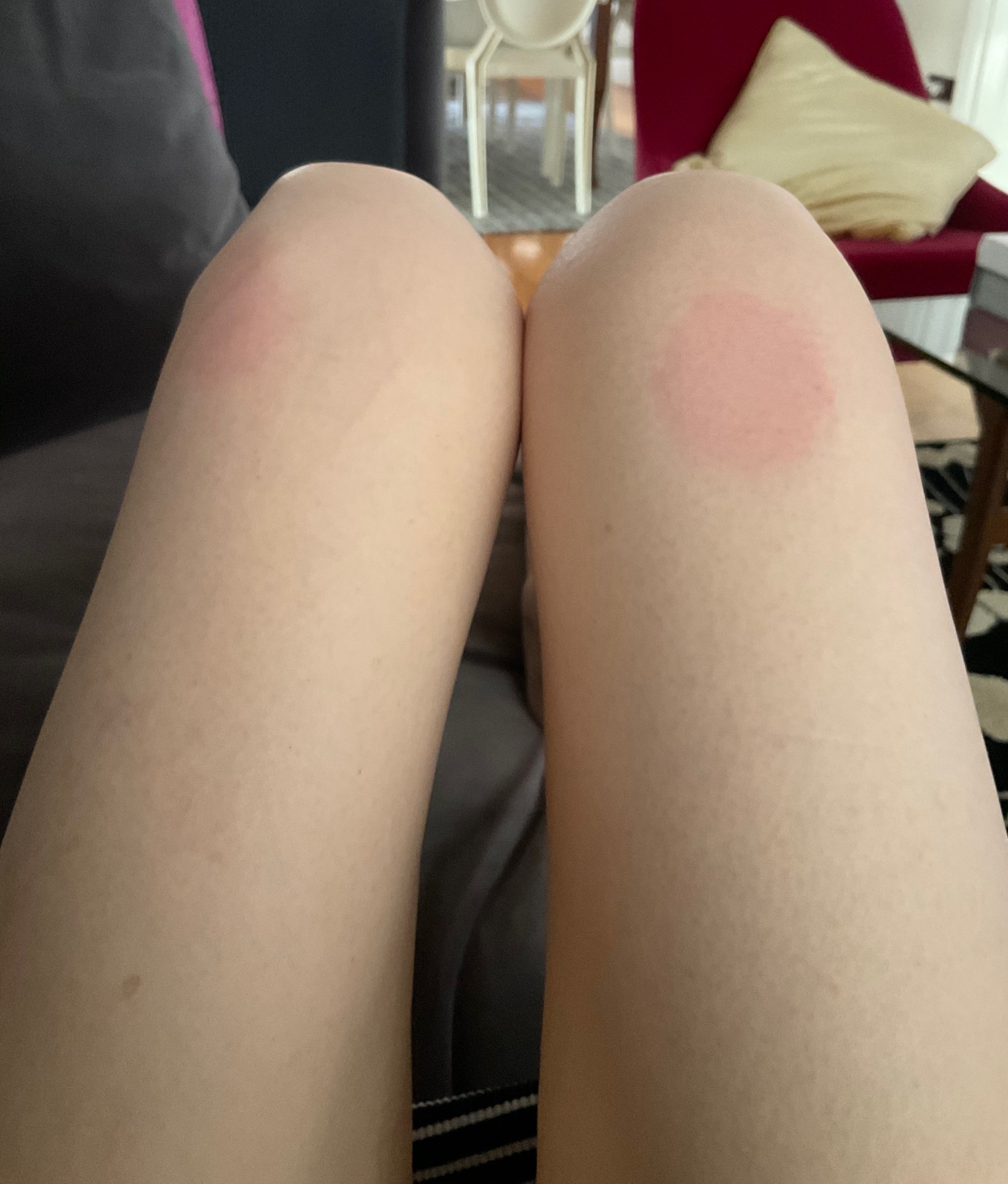 Thighs after weight loss