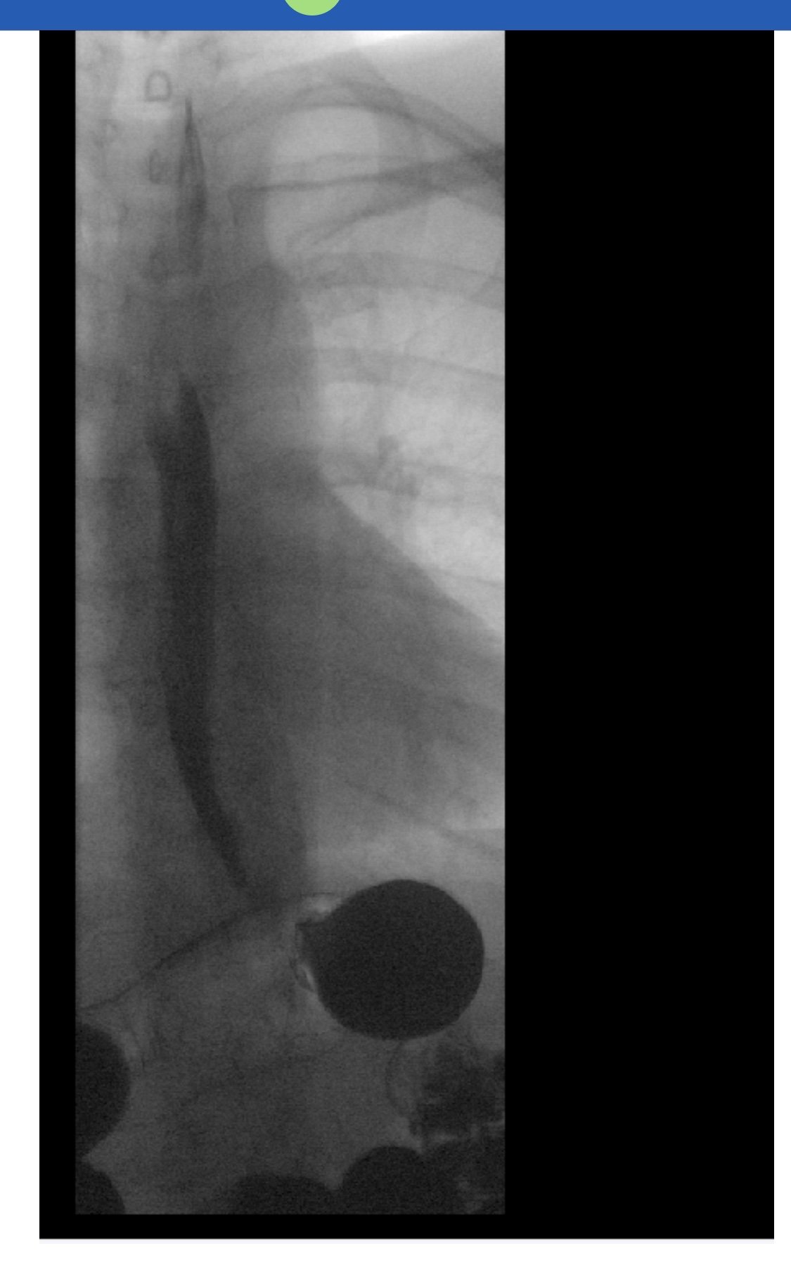 9 months out-VSG Fundus Complications