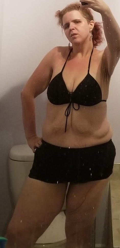 Fleur De Lys Abdominoplasty