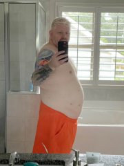 Side view 2 weeks post-surgery