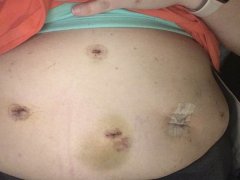 Swollen belly