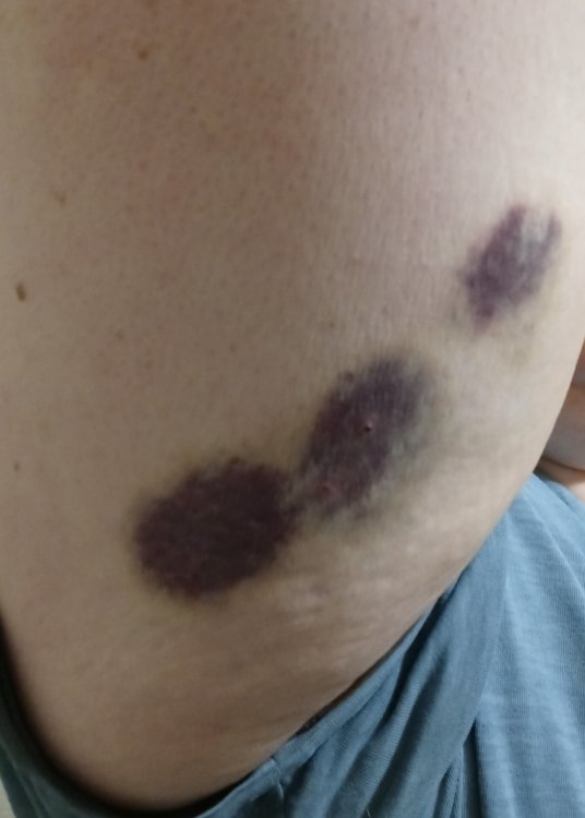 My arm after blood thinner shots.jpg