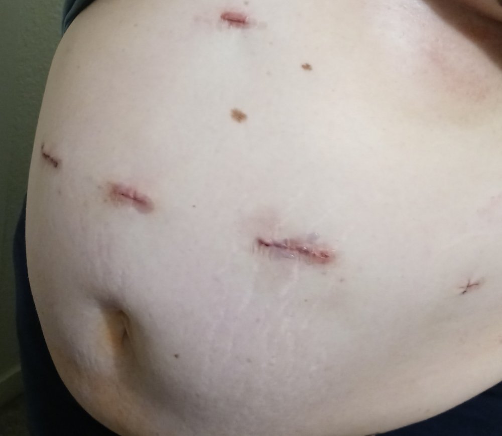 My incisions.jpg