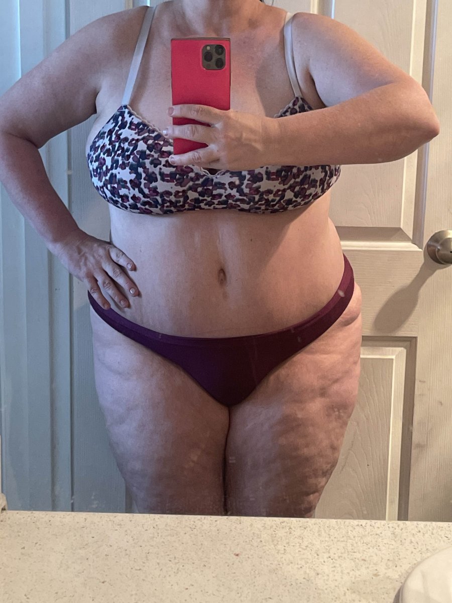 Pre Gastric sleeve