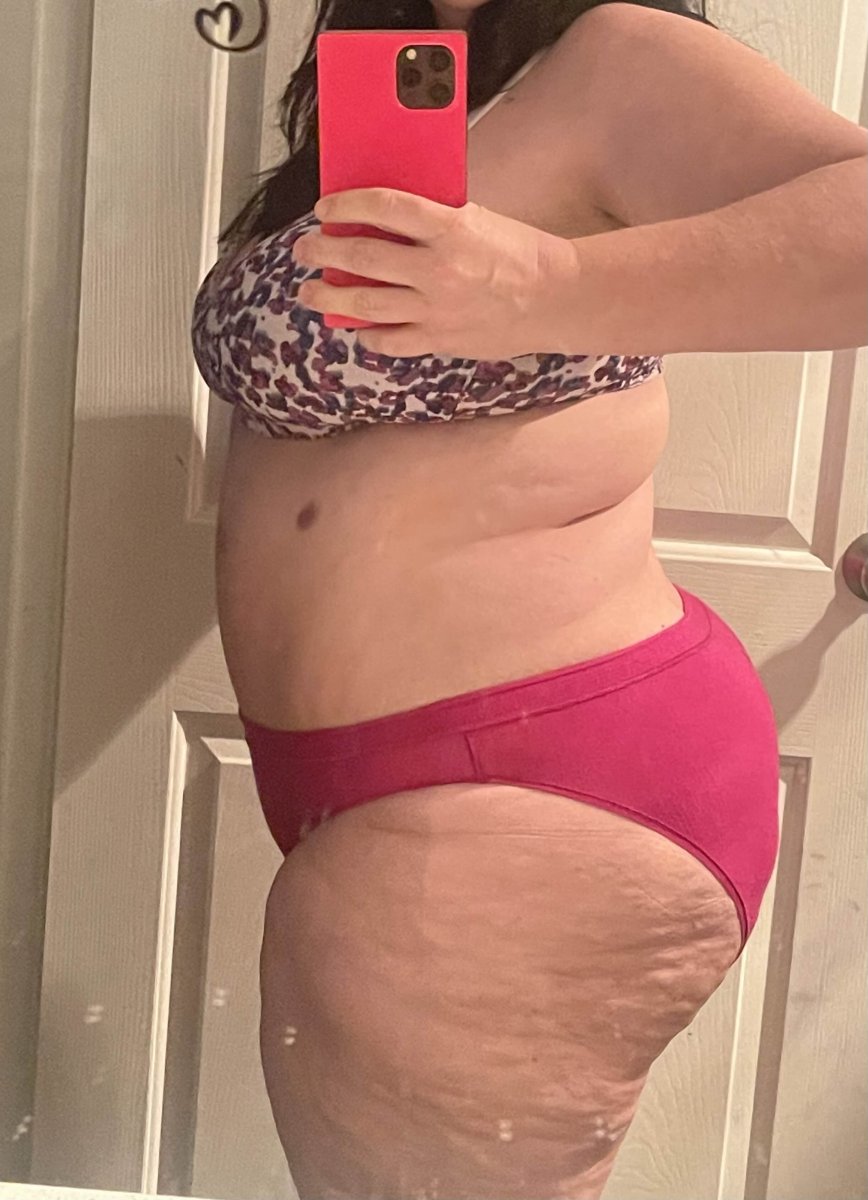 Post-op side