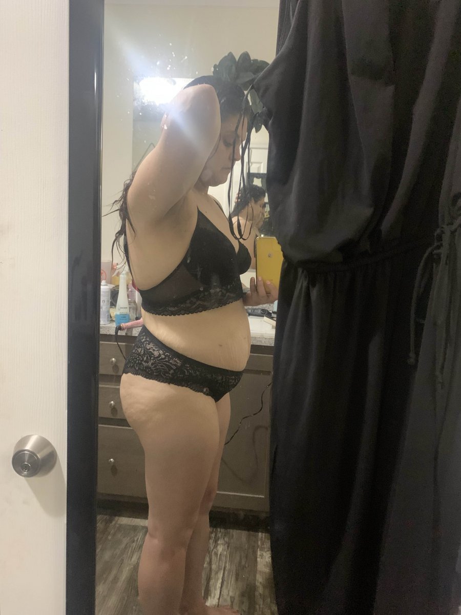 2 month Post Op