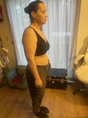 3 months after surgery.JPG