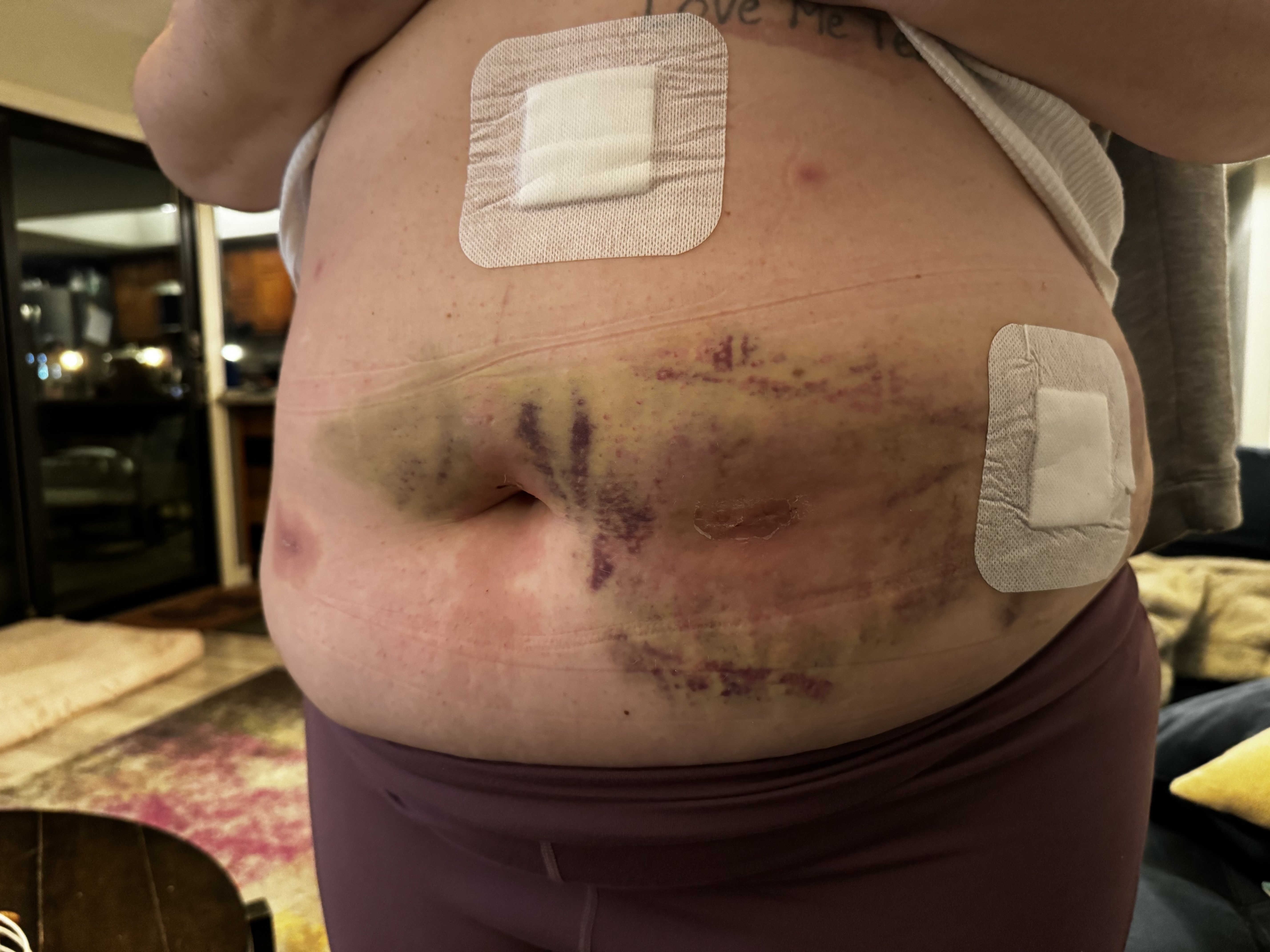 7 days post op - red circles around incisions
